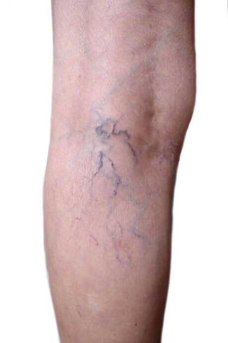 varicose veins symptoms Varicose Veins Symptoms Every Doctor Should Recognize