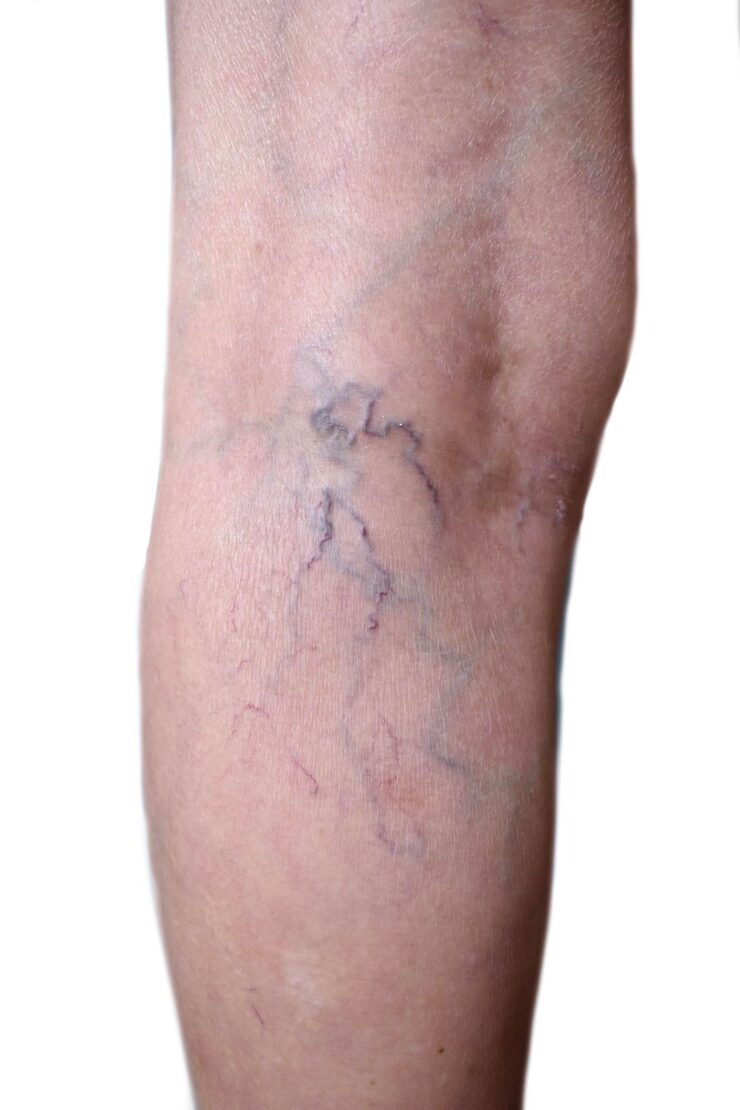 Best Veins Specialist for Same Day Consultation Help