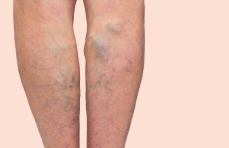 Varicose Veins