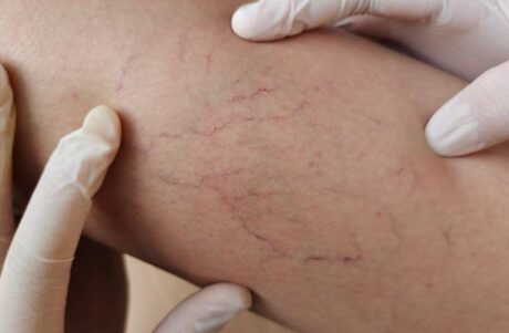 Varicose Veins