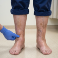 Vein Clinic Leading Veins Specialist for Cosmetic Vein Procedures