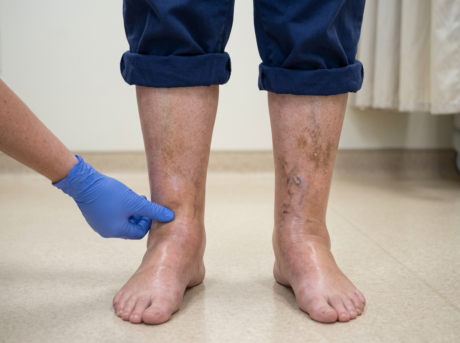 Veins Specialist Trusted Veins Specialist for Chronic Leg Vein Issues