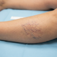 Vein Clinic What is the best way to stop varicose veins?