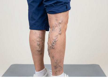 varicose vein What happens if a varicose vein is left untreated?