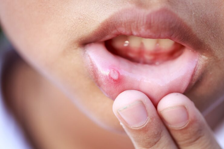 Wound Care Wound Care