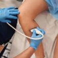 hair transplant oak brook What happens if a varicose vein is left untreated?