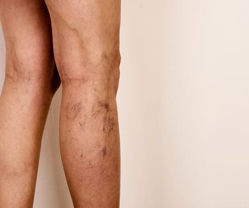 Vein Clinic & Doctor In Chicago Veins Specialist Near You for Effective Vein Solutions
