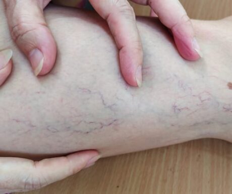 Varicose Veins What is the best way to stop varicose veins?