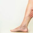 Varicose Veins Top Vascular Surgeon Services Near You