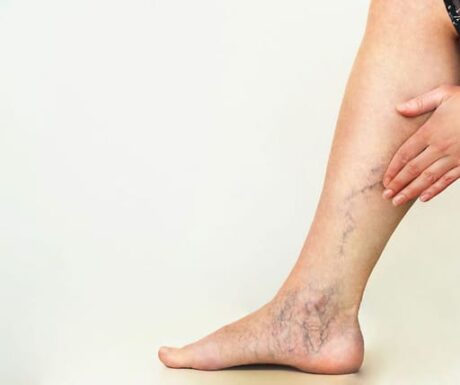 Varicose Veins Do Varicose Veins Go Away Without Treatment?