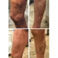 Vein Clinic Who Treats Varicose Veins in Chicago Effectively?