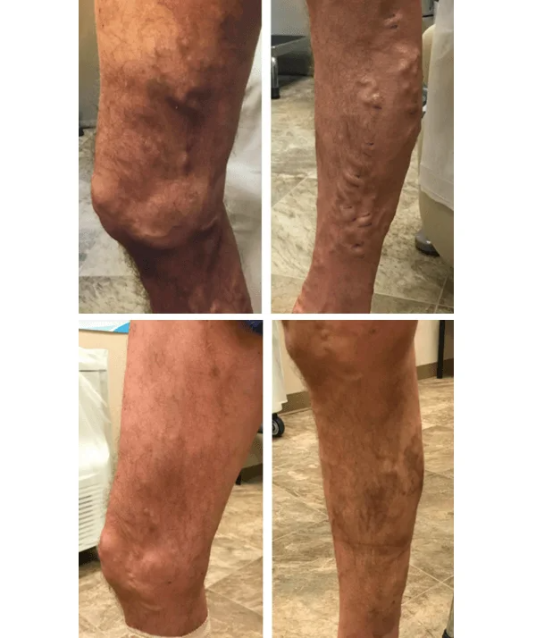Vein Clinic & Doctor In Chicago Who Treats Varicose Veins in Chicago Effectively?