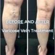 Varicose Veins Local Varicose Veins Doctor Options You Can Trust