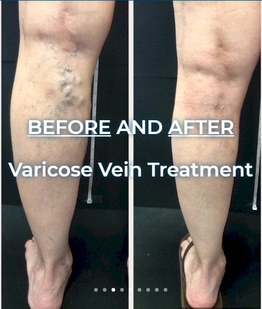 Vein Clinic & Doctor in Dyer Local Varicose Veins Doctor Options You Can Trust