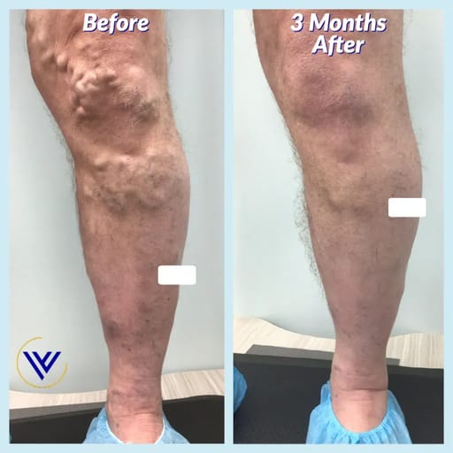 Vein Clinic & Doctor In Chicago Trusted Veins Specialist for Chronic Leg Vein Issues