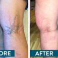 Are Varicose Veins in Chicago a Serious Concern?