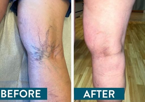 Varicose Vein Doctor Are Varicose Veins in Chicago a Serious Concern?