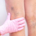 varicose veins