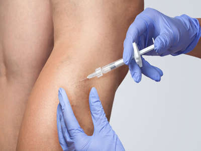 Varicose Veins