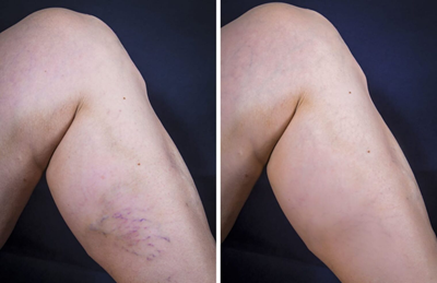 Spider Veins