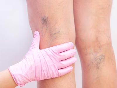 varicose veins