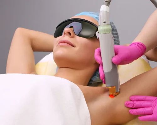 Laser Removal of Hair