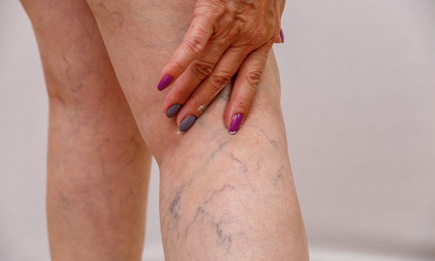 Varicose Veins