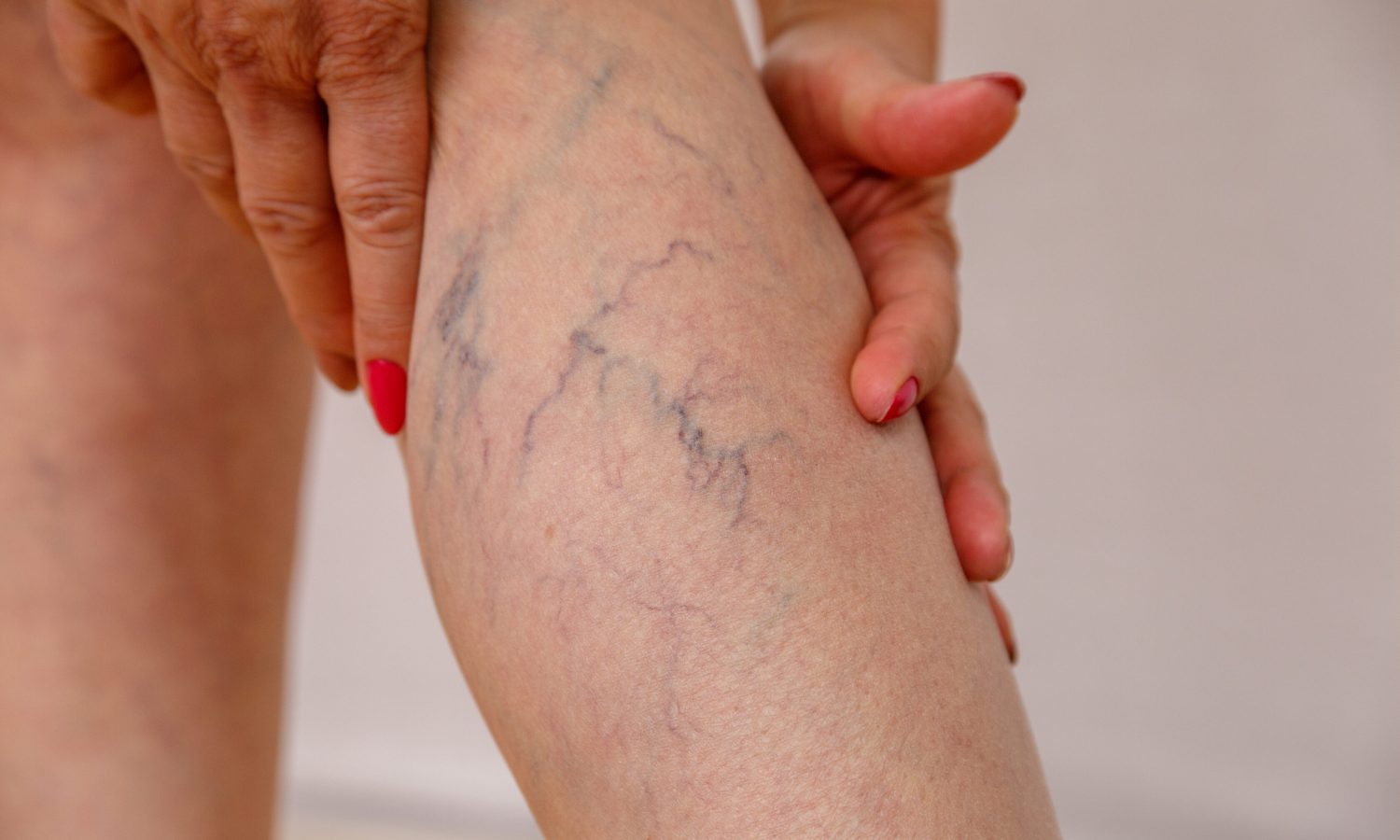 Varicose Veins