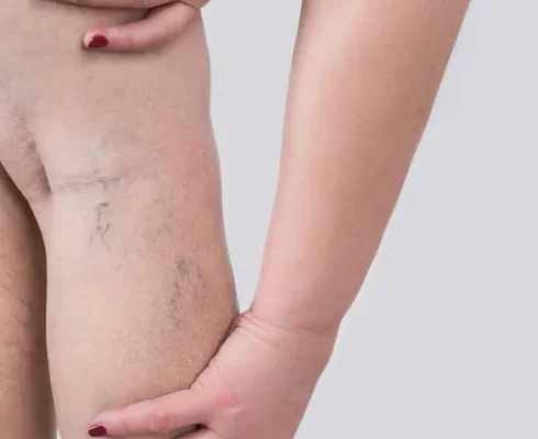Broken capillaries
